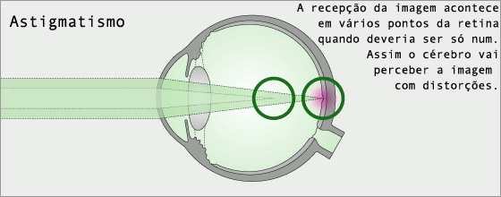 O que é o astigmatismo e a correcção com lentes de contacto
