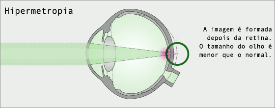 Explicação sobre a hipermetropia