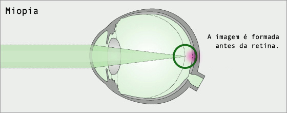 Explicação sobre a miopia