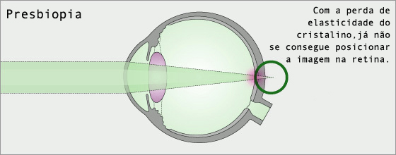 Explicação sobre a presbiopia chamada vista cansada